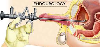 ENDOUROLOGIK JARROHLIK AMALIYOTI