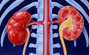 Surunkali buyrak kasalligi (SBK) belgilari qanday ?